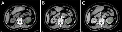 Differential Diagnosis of Type 1 and Type 2 Papillary Renal Cell Carcinoma Based on Enhanced CT Radiomics Nomogram